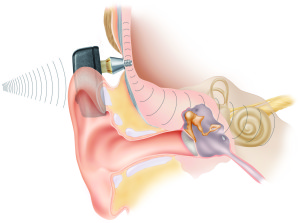 Cochlear Baha Implant 09/16/2007